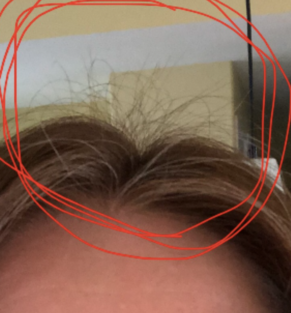 Telogen effluvium regrowth deals